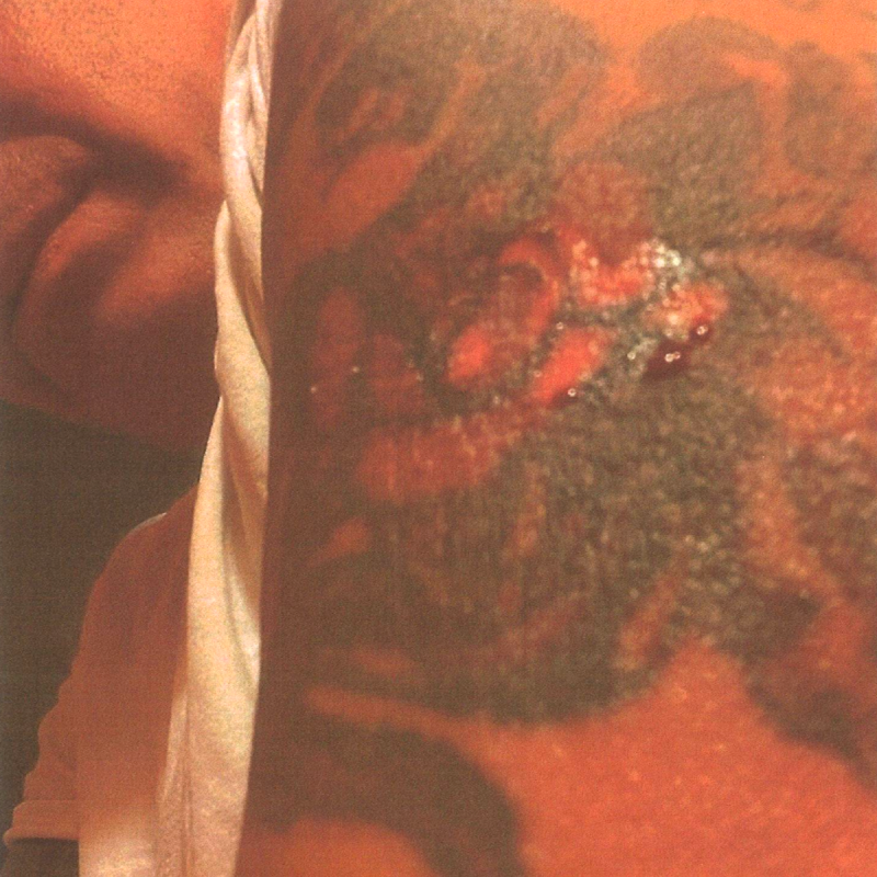 coffee burn